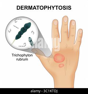 Dermatophytosis trichophyton rubrum infezione cutanea Foto Stock