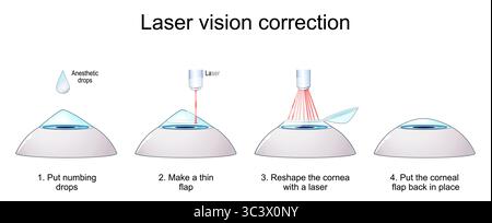 Fasi della correzione della visione laser. Processo LASIK. chirurgia laser dell'occhio. Poster dettagliato del vettore Illustrazione Vettoriale