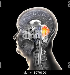 Immagine di una scansione a risonanza magnetica (MRI) colorata del cervello che mostra il cervelletto. Questa struttura prevedeva equilibrio, coordinamento e controllo motorio. Foto Stock
