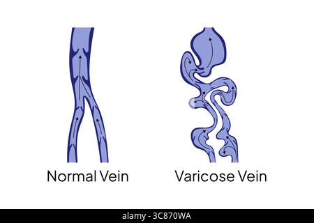 Illustrazione medica confrontando una vena normale con una vena varicosa, mostrando la differenza nel flusso sanguigno e nella struttura dei vasi per scopi educativi Illustrazione Vettoriale