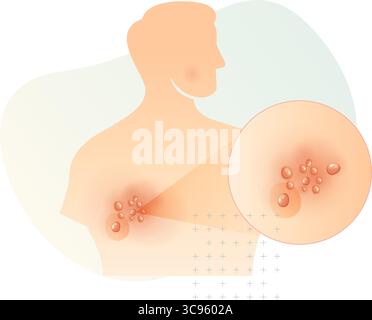 Un lato eruzioni sul retro - Herpes zoster - Shingles - Stock Illustration as EPS 10 file Illustrazione Vettoriale
