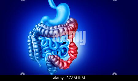 Sintomi IBS illustrazione medica e anatomica malattia digestiva e concetto di disturbo cronico come sindrome dell'intestino irritabile doloroso e dolore intestinale Foto Stock