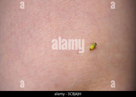 Insetto Leafhopper su macro di primo piano della pelle umana Foto Stock