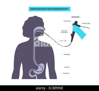 Illustrazione di una gastroscopia, nota anche come endoscopia superiore. Si tratta di una procedura in cui un endoscopio viene inserito attraverso la bocca per esaminare l'esofago, lo stomaco e il duodeno. Aiuta a diagnosticare e trattare condizioni come ulcere, infiammazione o tumori nel tratto digestivo superiore. Foto Stock