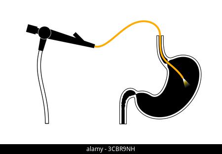 Illustrazione di una gastroscopia, nota anche come endoscopia superiore. Si tratta di una procedura in cui un endoscopio viene inserito attraverso la bocca per esaminare l'esofago, lo stomaco e il duodeno. Aiuta a diagnosticare e trattare condizioni come ulcere, infiammazione o tumori nel tratto digestivo superiore. Foto Stock