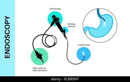 Illustrazione di una gastroscopia, nota anche come endoscopia superiore. Si tratta di una procedura in cui un endoscopio viene inserito attraverso la bocca per esaminare l'esofago, lo stomaco e il duodeno. Aiuta a diagnosticare e trattare condizioni come ulcere, infiammazione o tumori nel tratto digestivo superiore. Foto Stock