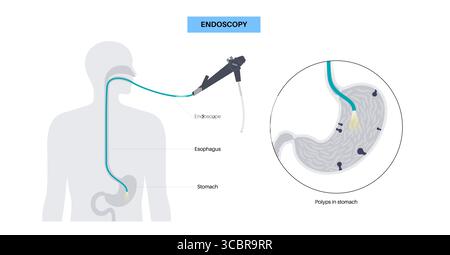 Illustrazione di una gastroscopia, nota anche come endoscopia superiore. Si tratta di una procedura in cui un endoscopio viene inserito attraverso la bocca per esaminare l'esofago, lo stomaco e il duodeno. Aiuta a diagnosticare e trattare condizioni come ulcere, infiammazione o tumori nel tratto digestivo superiore. Foto Stock