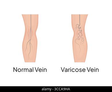 Confronto di vene normali e varicose nella gamba umana Illustrazione Vettoriale