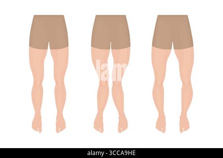 Diverse curvature e deformità delle gambe, genu varum, valgum e ricorvatum Illustrazione Vettoriale
