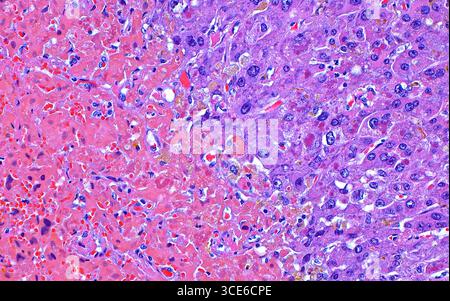 Micrografia leggera del carcinoma epatocellulare trattato necrotico. Il carcinoma epatocellulare è un cancro al fegato che nasce dagli epatociti, il tipo primario di cellule epatiche. Dopo il trattamento, ad esempio con la chemioterapia, le cellule tumorali muoiono o diventano necrotiche. In questa immagine, le cellule tumorali vitali sono visibili nella metà destra dell'immagine (blu-viola) e le cellule tumorali necrotiche del fegato sono visibili nella metà sinistra dell'immagine (rosso-rosa). Sezione di tessuto colorato con ematossilina ed eosina. Ingrandimento: 200x se stampato a 10 cm. Foto Stock