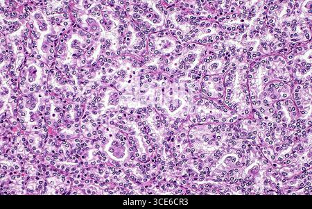 Micrografia leggera del carcinoma papillare a cellule renali. Il carcinoma papillare a cellule renali è un sottotipo di cancro renale. Uno dei modelli microscopici osservati in questo tumore è la formazione di tubuli compressi, come mostrato in questa immagine. Sezione di tessuto colorato con ematossilina ed eosina. Ingrandimento: 200x se stampato a 10 cm. Foto Stock