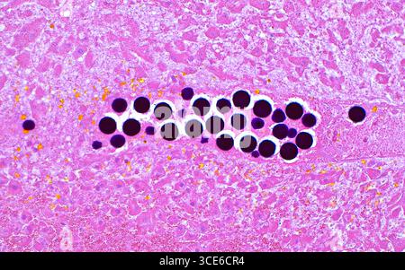 Micrografia leggera delle perle di radioembolizzazione Y90 nel carcinoma epatocellulare trattato. Le perle Y90 sono radioattive e vengono iniettate nei vasi sanguigni che alimentano i tumori del fegato, e in questo modo vengono utilizzate come trattamento per uccidere le cellule epatiche cancerose. In questa immagine, diverse perle Y90 (cerchi blu scuro) sono viste tra le cellule necrotiche di un carcinoma epatocellulare (rosa). Sezione di tessuto colorato con ematossilina ed eosina. Ingrandimento: 200x se stampato a 10 cm. Foto Stock