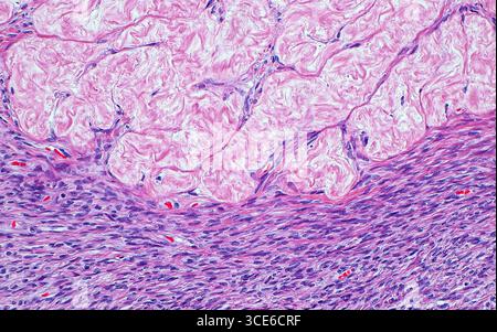 Micrografia leggera di un corpus ovarico albicano. Un corpus albicans è il residuo fibroso del corpus luteum, una struttura che si forma dopo l'ovulazione o il rilascio di un ovulo dall'ovaio. Il corpus albicans è visto qui nella metà superiore dell'immagine (rosa), mentre la maggior parte della metà inferiore dell'immagine mostra cellule stromali ovariche e tessuto connettivo (punti allungati viola scuro con sottili fili rosa). Si osservano anche alcuni globuli rossi (punti rossi luminosi) all'interno di piccoli vasi sanguigni. Sezione di tessuto colorato con ematossilina ed eosina. Ingrandimento: 200x se stampato a 10 cm. Foto Stock