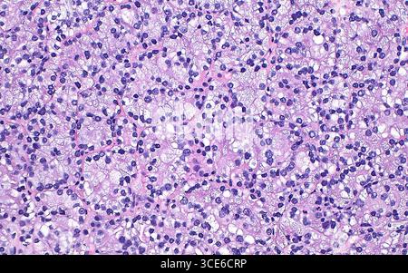 Micrografia leggera del carcinoma papillare a cellule renali. Il carcinoma papillare a cellule renali è un sottotipo di cancro renale. Uno dei modelli microscopici osservati in questo tumore è la formazione di cellule chiare (azzurro-bianco pallido). Sezione di tessuto colorato con ematossilina ed eosina. Ingrandimento: 200x se stampato a 10 cm. Foto Stock