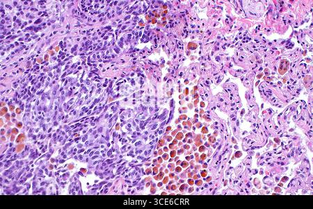 Micrografia leggera di un tumore neuroendocrino carcinoide del polmone. Il polmone è un sito comune per l'insorgenza di tumori neuroendocrini. Le cellule tumorali, osservate nella metà sinistra di questa immagine, presentano nuclei piccoli da ovali rotondi a leggermente allungati (blu scuro) e moderati quantitativi di citoplasma (blu chiaro-rosa intorno ai punti blu). Le cellule tumorali sono visibili accanto ai normali alveoli polmonari (rosa, metà destra dell'immagine). Ci sono anche diverse cellule macrofagiche con pigmento di emosiderina visto (marrone). Sezione di tessuto colorato con ematossilina ed eosina. Ingrandimento: 200x se stampato a 10 cm. Foto Stock