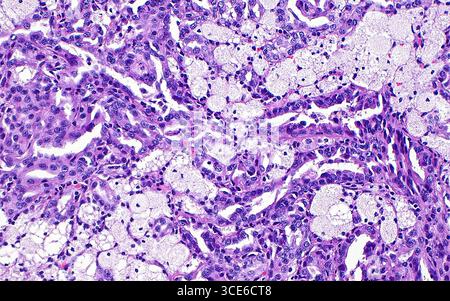 Micrografia leggera del carcinoma papillare a cellule renali. Il carcinoma papillare a cellule renali è un sottotipo di cancro renale. Una delle caratteristiche microscopiche spesso osservate in questo tumore è la presenza di macrofagi schiumosi (aggregati azzurri-bianchi di strutture circolari), come si vede in questa immagine. Sezione di tessuto colorato con ematossilina ed eosina. Ingrandimento: 200x se stampato a 10 cm. Foto Stock