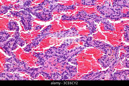 Micrografia leggera del carcinoma papillare a cellule renali. Il carcinoma papillare a cellule renali è un sottotipo di cancro renale. Questa immagine mostra le cellule del tumore (rosa-viola) disposte in tubuli di flusso con abbondante emorragia (rosso brillante). Sezione di tessuto colorato con ematossilina ed eosina. Ingrandimento: 200x se stampato a 10 cm. Foto Stock