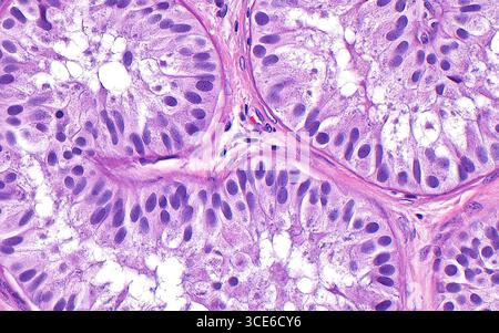 Sindrome di Sertoli solo cellulare, micrografia leggera Foto Stock