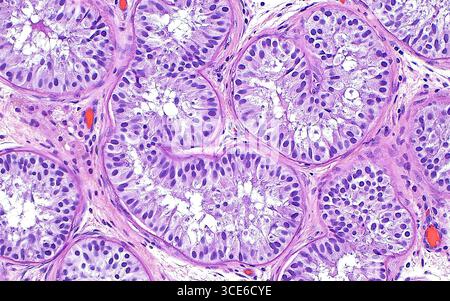 Sindrome di Sertoli solo cellulare nel testicolo, micrografia leggera Foto Stock