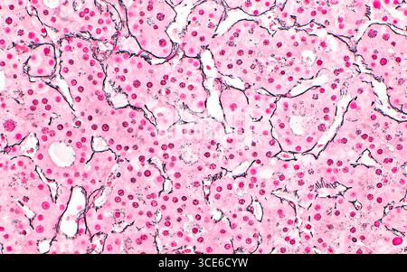 Micrografia leggera del carcinoma epatocellulare. Il carcinoma epatocellulare è un cancro al fegato che ha origine dalle cellule epatiche stesse. Le cellule del tumore (rosa) sono disposte in piastre ispessite delimitate da fibre reticoline (sottili linee nere). Sezione di tessuto colorato con reticolina. Ingrandimento: 200x se stampato a 10 cm. Foto Stock