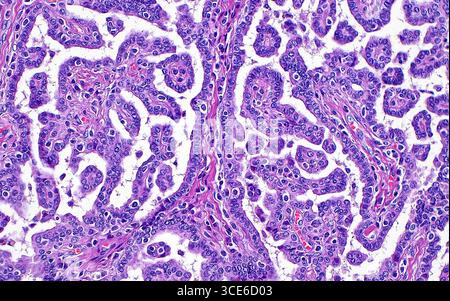 Micrografia leggera del carcinoma papillare a cellule renali. Il carcinoma papillare a cellule renali è un sottotipo di cancro renale. Le cellule tumorali (blu-viola) sono disposte in papilla o strutture simili a dita che contengono fibre di collagene (rosa) e vasi sanguigni con globuli rossi (rosso brillante). Sezione di tessuto colorato con ematossilina ed eosina. Ingrandimento: 200x se stampato a 10 cm. Foto Stock