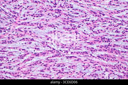 Micrografia leggera del carcinoma a cellule renali a cellule mandrino tubulare mucinoso, che è un tipo di cancro renale. Il tumore è costituito da cellule con morfologia del mandrino (allungata) disposte in tubuli e presenta mucina intervallata (azzurro). Sezione di tessuto colorato con ematossilina ed eosina. Ingrandimento: 200x se stampato a 10 cm. Foto Stock