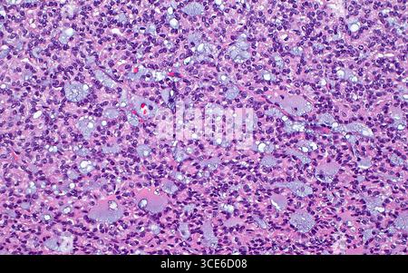 Micrografia leggera del carcinoma papillare a cellule renali. Il carcinoma papillare a cellule renali è un sottotipo di cancro renale. Uno dei modelli microscopici osservati in questo tumore è la disposizione delle cellule tumorali (blu-viola) come strutture tubulari che a volte contengono mucina (azzurro). Sezione di tessuto colorato con ematossilina ed eosina. Ingrandimento: 100x se stampato a 10 cm. Foto Stock