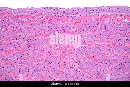 Micrografia leggera della parete di una vena renale. La vena renale è la vena principale che raccoglie il sangue dopo che è passato attraverso i reni. La parete della vena renale presenta frammenti di muscolo liscio (aree rosa più chiare con molti punti blu) tra gli stromi fibrosi (aree rosa più scure tra i frammenti rosa chiaro). Sezione di tessuto colorato con ematossilina ed eosina. Ingrandimento: 100x se stampato a 10 cm. Foto Stock