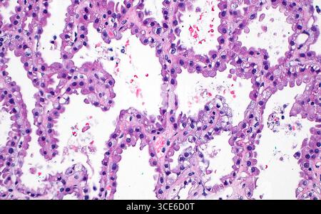 Micrografia leggera del carcinoma papillare a cellule renali. Il carcinoma papillare a cellule renali è un sottotipo di cancro renale. Uno dei modelli microscopici osservati in questo tumore è la disposizione delle cellule tumorali come strutture tubulari (spazi bianchi aperti allineati da cellule rosa), come mostrato in questa immagine. Sezione di tessuto colorato con ematossilina ed eosina. Ingrandimento: 200x se stampato a 10 cm. Foto Stock