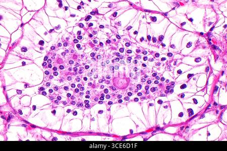 Micrografia leggera della traslocazione t(6,11) del carcinoma a cellule renali. Questo tipo di cancro renale presenta una traslocazione caratteristica tra i cromosomi 6 e 11. Istologicamente, questo tipo di cancro renale mostra due popolazioni di cellule: Cellule più grandi con citoplasma chiaro (periferia dell'immagine) disposte intorno a cellule più piccole (centro dell'immagine). Le cellule più piccole sono presenti anche tra i noduli di materiale ialino (strutture a inchiostro rotondo), un'altra caratteristica morfologica. Sezione di tessuto colorato con ematossilina ed eosina. Ingrandimento: 400x se stampato a 10 cm. Foto Stock