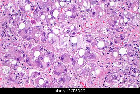 Micrografia leggera della steatosi in un carcinoma epatocellulare. Il carcinoma epatocellulare è un cancro al fegato che nasce dagli epatociti o dalle cellule primarie del fegato. Il carcinoma epatocellulare spesso può essere visto con steatosi o accumulo di grasso all'interno delle cellule tumorali. La steatosi appare come spazi bianchi rotondi microscopici, come si vede in questa immagine. Sezione di tessuto colorato con ematossilina ed eosina. Ingrandimento: 200x se stampato a 10 cm. Foto Stock