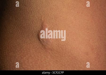 Primo piano di una cicatrice curativa, che mostra la consistenza e i cambiamenti di colore sulla pelle umana Foto Stock