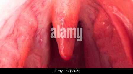Infiammazione dell'uvula nella cavità orale a causa di infezione e virus. Il trattamento della malattia è l'uvulite. Gola rossa a causa di malattia, macro Foto Stock