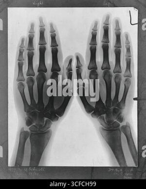 Due mani, viste con raggi X, 1896. Foto Stock