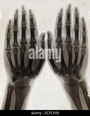 Due mani, viste con raggi X, 1896. Foto Stock