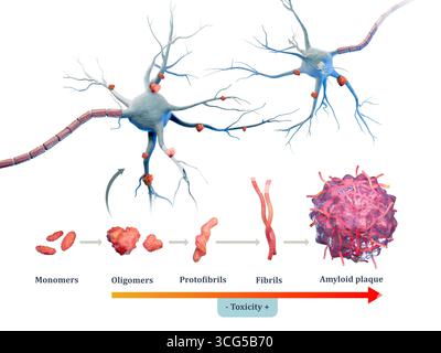 Diagramma che mostra diversi passi che portano alla formazione di placche amiloidi nella malattia di alzheimer. Illustrazione digitale, rendering 3D. Foto Stock