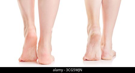 Suola femminile asciutta e fessurata di piedi e piedi femminili puliti pedicure isolati su sfondo bianco con percorso di ritaglio. Primo piano prima e dopo il risultato. Foto Stock