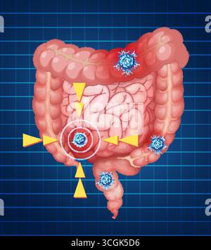Illustrazione vettoriale dell'intestino umano con cellule tumorali evidenziate su un brillante background educativo. Illustrazione Vettoriale