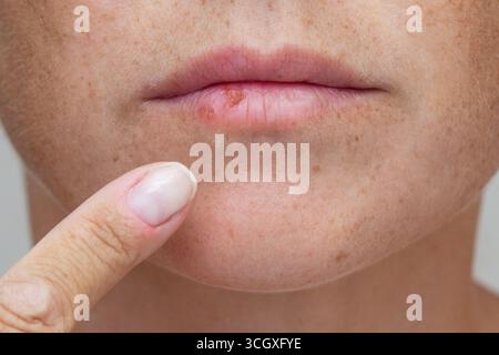 Primo piano di una donna che indica l'irritazione delle labbra Foto Stock