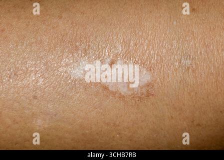 Primo piano di una cicatrice ipertrofica pallida e ben guarita sull'avambraccio di una persona. Foto Stock