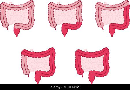 Tipi di colite ulcerosa. Illustrazione vettoriale Illustrazione Vettoriale