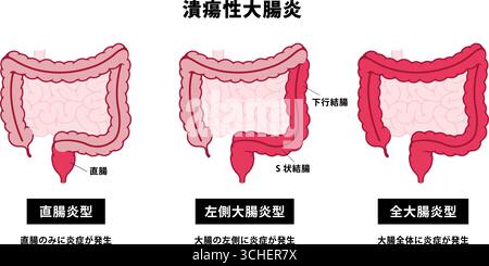 Tipi di colite ulcerosa. Illustrazione vettoriale Illustrazione Vettoriale