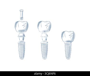 Illustrazione delle parti dell'impianto dentale in stile grafico con sfondo blu su sfondo bianco. Illustrazione Vettoriale