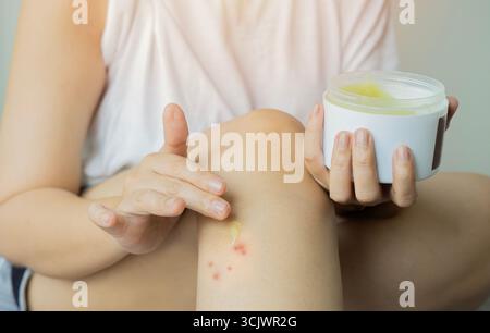 Giovane donna allergica con allergia all'orticaria eruzione cutanea prurito applicando crema sulla gamba in camera da letto. Primo piano, messa a fuoco selettiva. Foto Stock