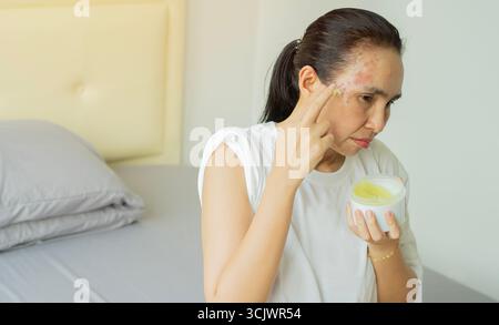 Primo piano di sconvolto donna asiatica adulta che applica idratante sulla pelle scottata dal sole in camera da letto. Il concetto di dermatologia Foto Stock