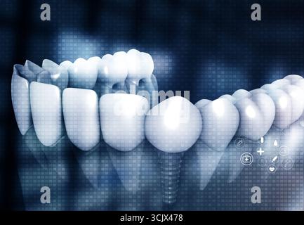 Impianti dentali, denti umani su basi scientifiche. illustrazione 3d. Foto Stock