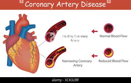 Illustrazione medica della progressione della coronaropatia con anatomia cardiaca e stadi di blocco dell'arteria. Diagramma di progressione della coronaropatia. Illustrazione Vettoriale