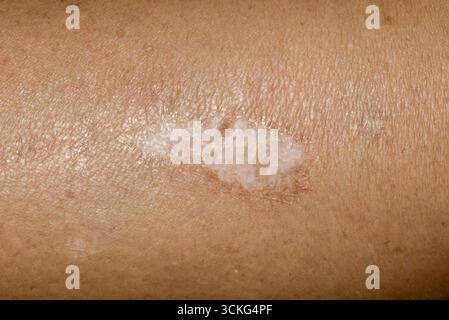 Primo piano di una cicatrice ipertrofica pallida e ben guarita sull'avambraccio di una persona. Foto Stock