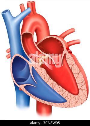 Illustrazione della stenosi della valvola aortica, una condizione cardiaca in cui la valvola aortica si restringe, impedendo il flusso sanguigno dal ventricolo sinistro del cuore all'arteria principale. Questo blocco può causare sintomi come mancanza di respiro e affaticamento. Foto Stock