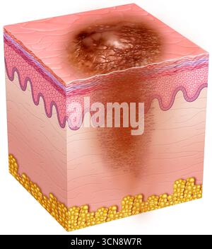 Illustrazione della cute con carcinoma a cellule squamose. Questo tumore maligno della pelle ha origine nelle cellule dello strato esterno dell'epidermide, che sono spesso esposte al sole. In genere si presenta come una macchia rossastra, squamosa o una scossa che non guarisce, o come un'ulcera che sanguina e può crescere. L'esposizione prolungata alle radiazioni UV è la causa principale. Foto Stock